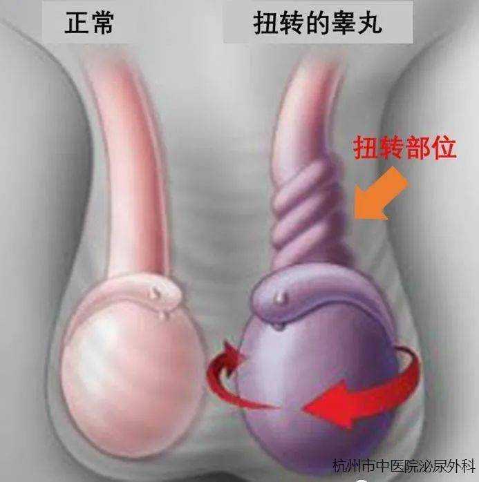 如何判斷睪丸是否發生扭轉，如何判斷睪丸扭轉？