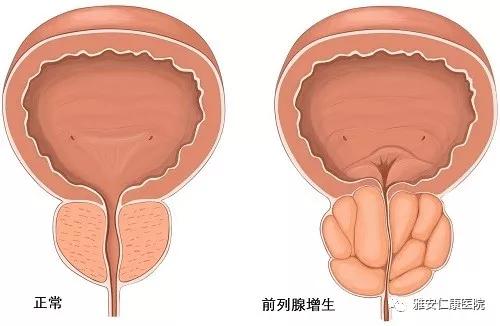 前列腺增生，藥物治療的選擇與最佳用藥探討，前列腺增生藥物治療的選擇及最佳用藥探討