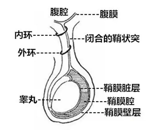 鞘膜積液，無需手術，其他治療方法同樣有效，鞘膜積液非手術治療方法同樣有效，無需手術也能康復