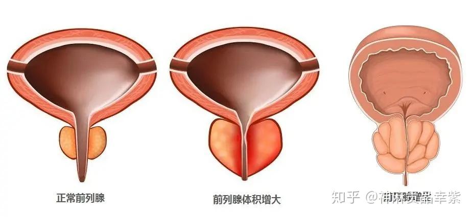 前列腺增生肥大的原因及其影響，前列腺增生肥大的原因、影響及治療方法探討