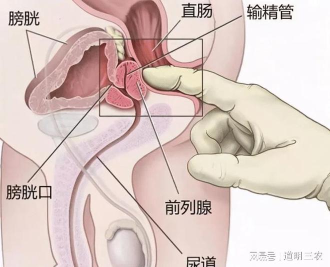 前列腺炎會治愈嗎，深入了解與治療策略，前列腺炎的治愈可能性，深入了解與治療策略探討