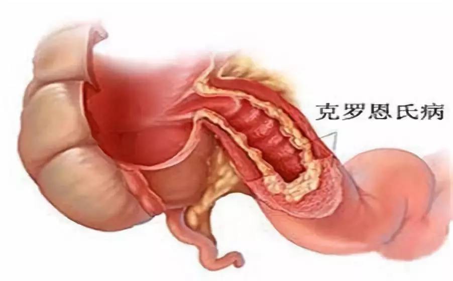 克羅恩病最常見的癥狀及其影響，克羅恩病常見癥狀及其影響概述